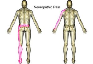 Extreme OG neuropathy